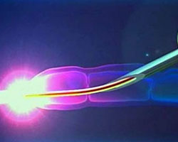 Эндовозальная склеротерапия