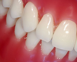 Лечение заболеваний десен